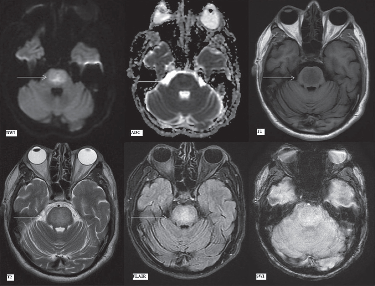 Magnetic resonance imaging findings on day 19. Diffusion-weighted imaging, apparent diffusion coefficient map, T1-weighted, T2-weighted, fluid attenuation inversion recovery and susceptibility-weighted imaging images (as labeled) at the level of pons. Arrows showing trident shaped pontine signal abnormality on diffusion-weighted imaging and apparent diffusion coefficient images with central restricted diffusion (hyperintense on diffusion-weighted imaging, hypointense on apparent diffusion coefficient) surrounded by rim of vasogenic edema (minimally hyperintense on diffusion-weighted imaging, thin hyperintense rim on apparent diffusion coefficient due to intrinsic T2 effect). Subsequent images with arrows depicting hypointense T1-weighted and hyperintense T2/fluid attenuation inversion recovery signal alteration in central pons. No abnormality is seen on susceptibility-weighted imaging images