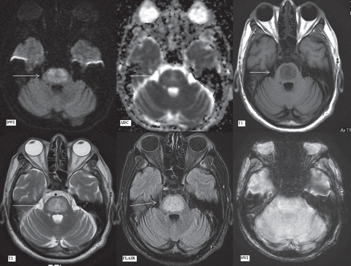 Magnetic resonance imaging findings on day 36. Diffusion-weighted imaging, apparent diffusion coefficient map, T1-weighted, T2-weighted, fluid attenuation inversion recovery and susceptibility-weighted imaging images (as labeled) at the level of pons. Arrows depict trident-shaped mild hyperintensity on diffusion-weighted imaging and apparent diffusion coefficient images, hyperintense signal on T2-weighted and fluid attenuation inversion recovery images with corresponding hypointensity on T1-weighted images in central pontine tegmentum and basis pontis sparing the ventrolateral pons. The extent of signal abnormalities has marginally decreased due to a reduction in vasogenic edema as compared to the previous magnetic resonance imaging