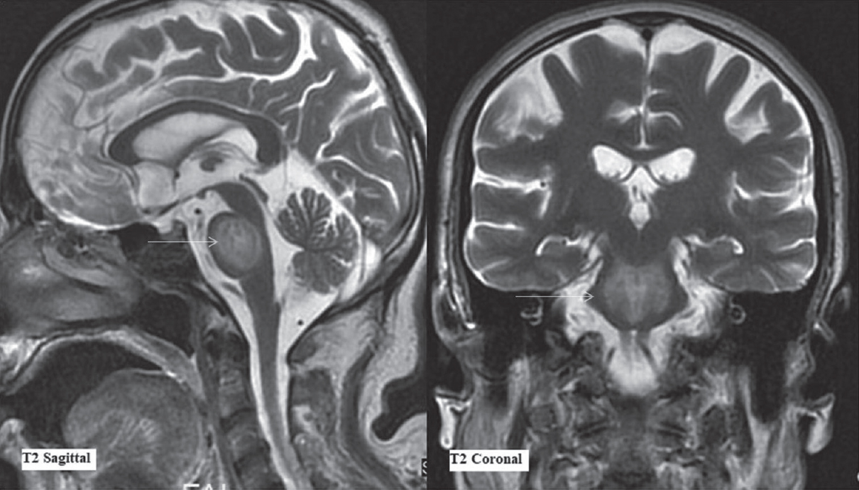 Magnetic resonance imaging findings on day 36. T2-weighted sagittal and coronal sections (as labeled) at the level of pons. Arrows depict the extent of T2-weighted signal abnormality in central pons characteristically sparing the ventrolateral pons