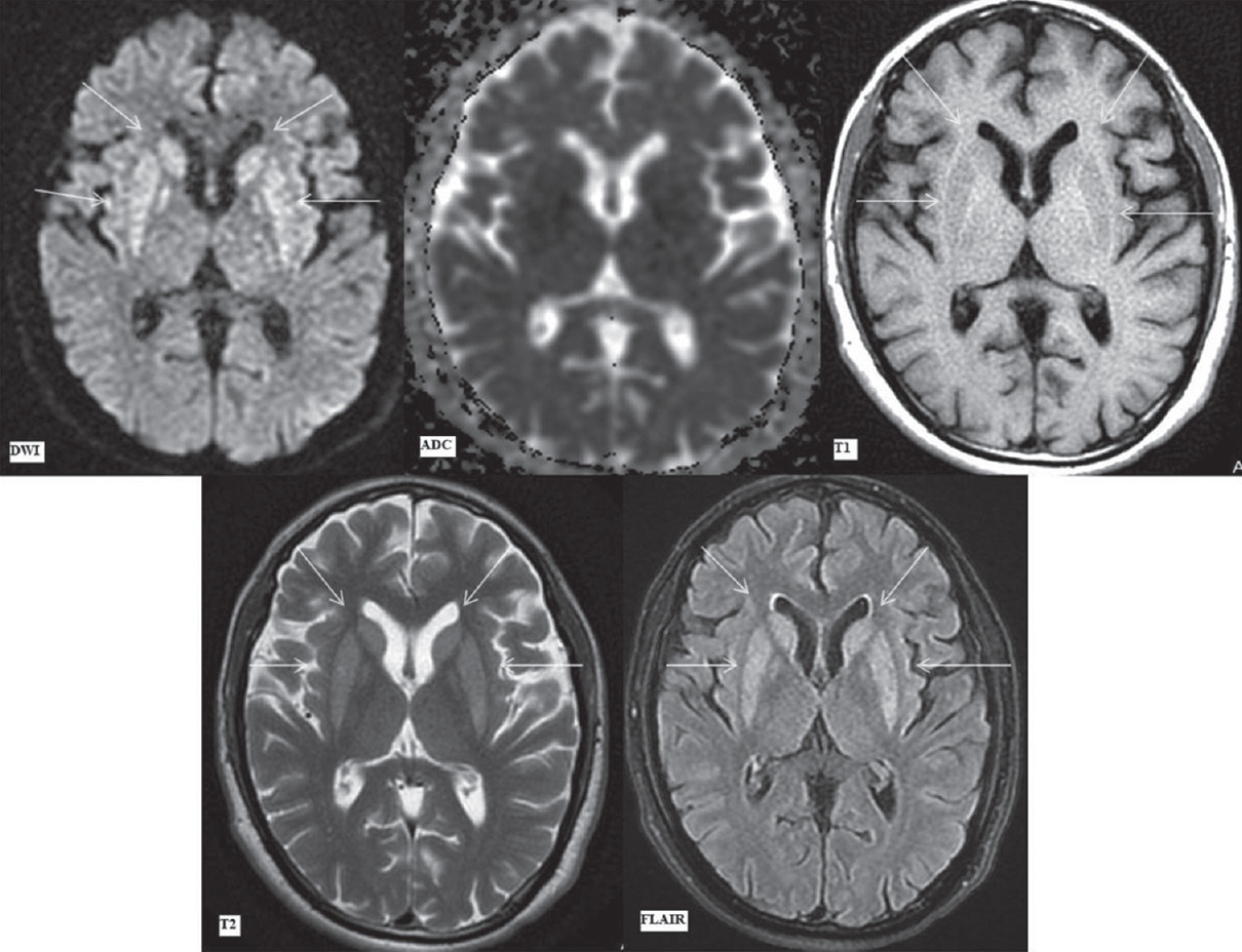 Magnetic resonance imaging findings on day 36. Diffusion-weighted imaging, apparent diffusion coefficient map, T1-weighted, T2-weighted, and fluid attenuation inversion recovery images (as labeled) at the level of basal ganglia. diffusion-weighted imaging image showing symmetrical hyperintense signal in bilateral caudate nuclei (upper arrows) and putamina (lower arrows) without any apparent diffusion coefficient reversal. Symmetrical corresponding T1 hypointense, T2 hyperintense, and fluid attenuation inversion recovery hyperintense signal in bilateral caudate nuclei (upper arrows) and putamina (lower arrows). There is a reduction in edema in these areas as compared to the previous magnetic resonance imaging