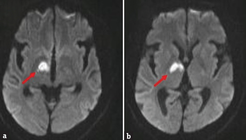 Magnetic resonance imaging brain diffusion-weighted imaging images (axial cuts) showing acute infarct in the right thalamus involving the anterior and paramedian regions (a) and the hypothalamus (b)