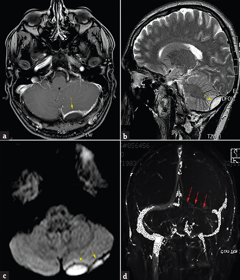 Admission axial postcontrast T1-weighted magnetic resonance image (a) revealing an enhancing left retrocerebellar epidural abscess. Sagittal T2-weighted (b) and diffusion-weighted (c) images showing the collection as a high-intensity area (yellow arrows). (d) Magnetic resonance venography demonstrating left lateral sinus thrombosis (red arrows)