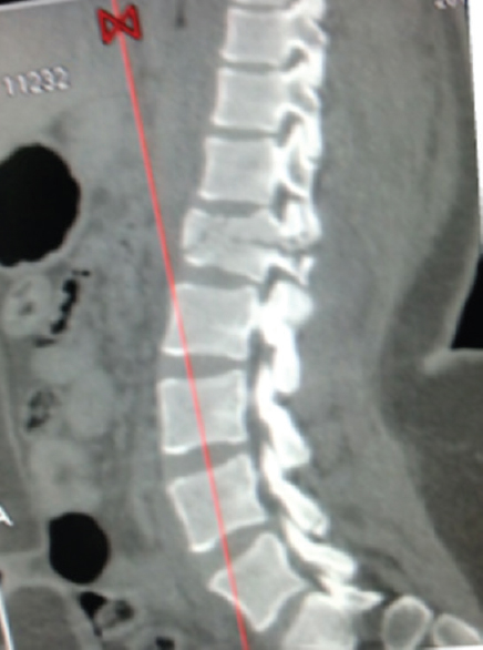 Computed tomography image showing L1 bony chance fracture