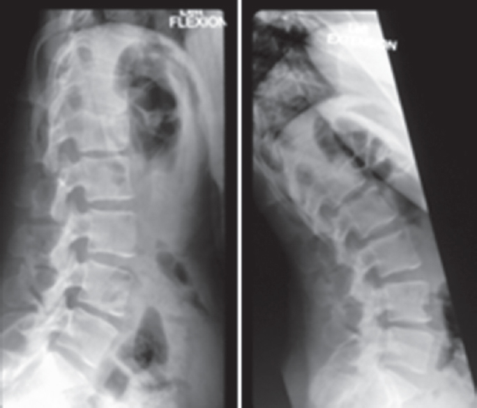 Dynamic X-ray images showing satisfactory bone union