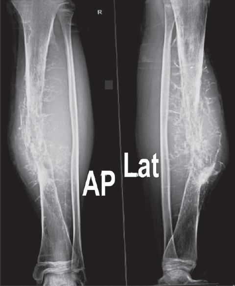 Anteroposterior and lateral radiograph of the right leg showing lytic lesion with large soft-tissue component and hair-on-end periosteal reaction in mid-diaphysis of tibia