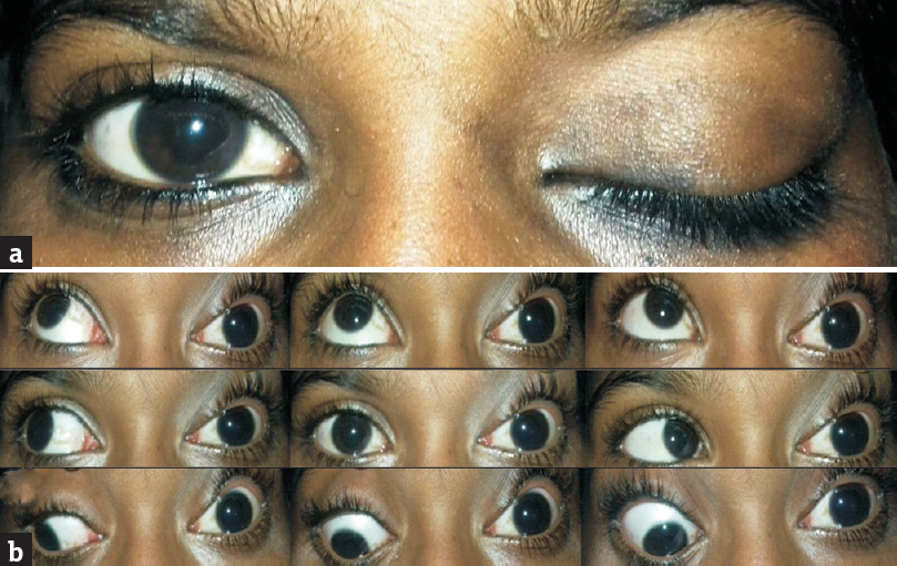 Left eye. (a) Total ptosis, (b) total ophthalmoplegia