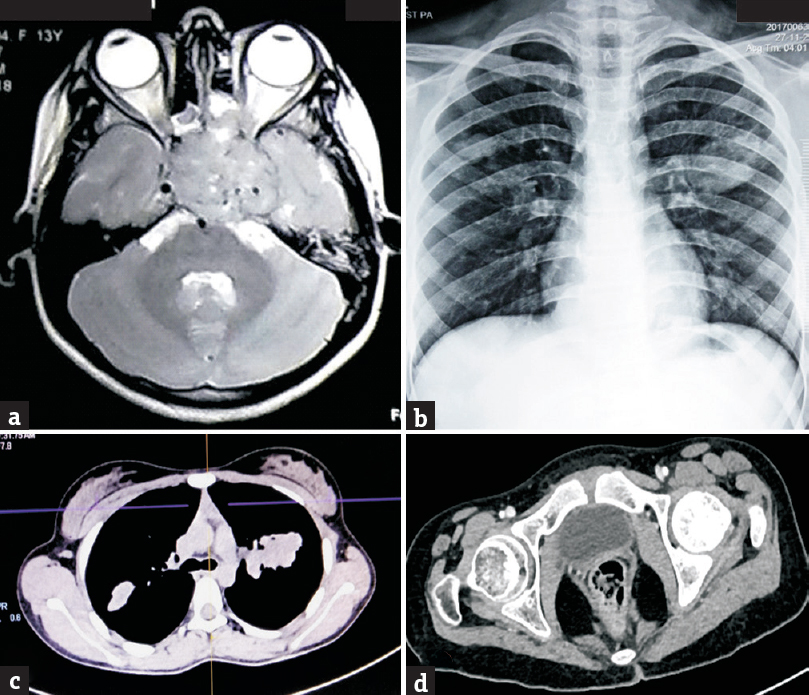 (a) Magnetic resonance imaging brain showing large mass based on sellar/suprasellar region extending to the left orbital apex, ethmoidal air cells, and cavernous sinus. (b) Chest X-ray showing well-defined opacities in bilateral mid-zones. (c) Computed tomography chest showing irregular soft-tissue lesions in lungs and mediastinum. (d) Computed tomography pelvis showing lytic lesion in the left femoral head