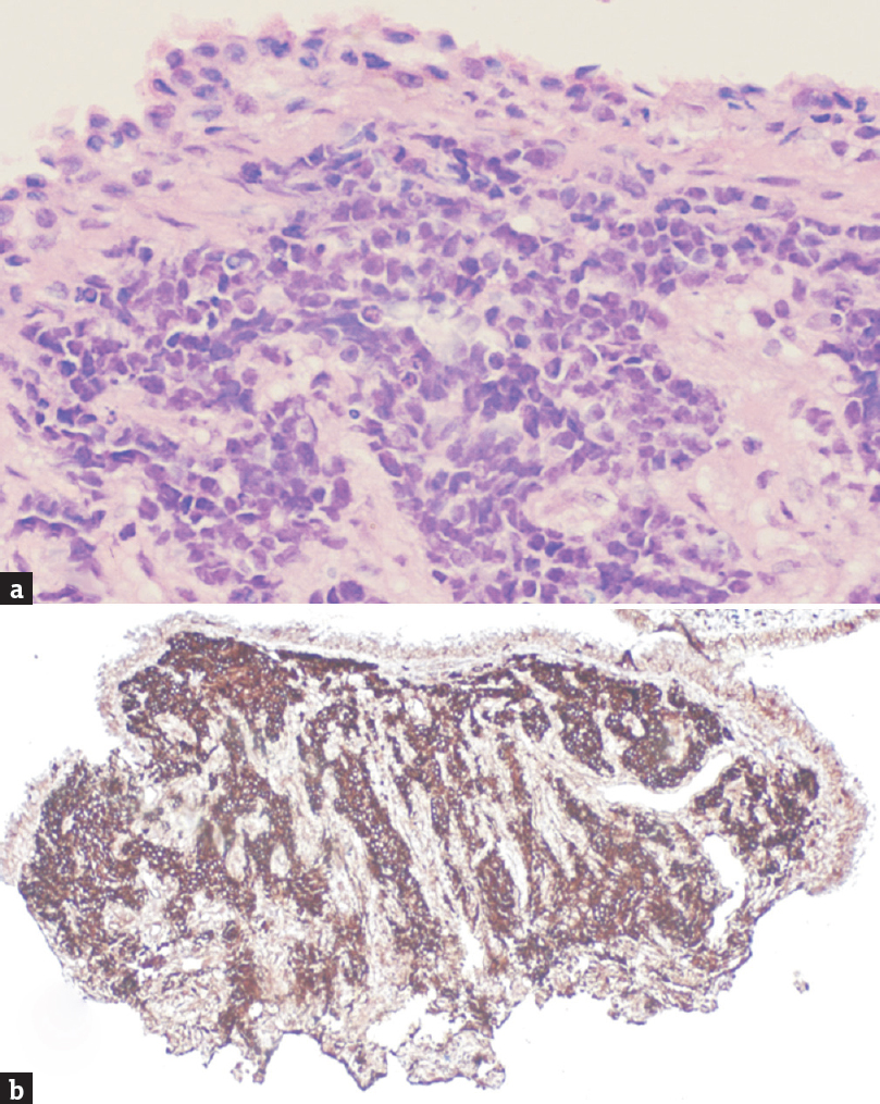 (a) H and E-stained section of nasopharyngeal punch biopsy specimen showing nests of small round blue cells, (b) Strong CD99 immunoreactivity