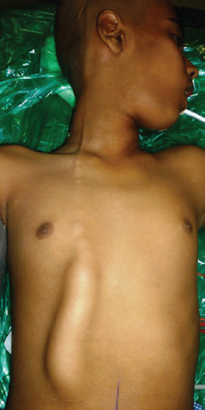 Clinical picture showing an elongated swelling over the anterior abdominal and chest wall with a beaded appearance at the upper end