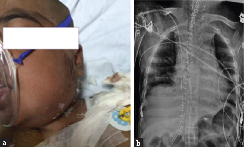 (a) Diffuse swelling on the left side of the face and neck. (b) Widened mediastinum on chest X-ray