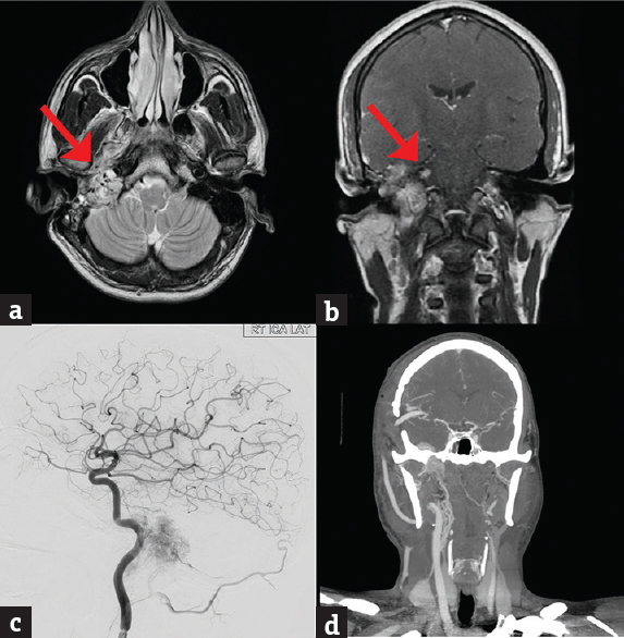 (a and b) MRI images axial T2 (a), post contrast coronal (b) showing an extensive skull base glomus jugulare encasing the carotid artery. The red arrows point to the tumour within the petrous encasing the carotid, (c) preoperative digital subtraction cerebral angiography showing the tumor blush surrounding the cervical and petrous carotid artery, (d) computed tomography angiogram (postoperative) showing a patent high-flow saphenous vein graft from the cervical external carotid artery to middle cerebral artery