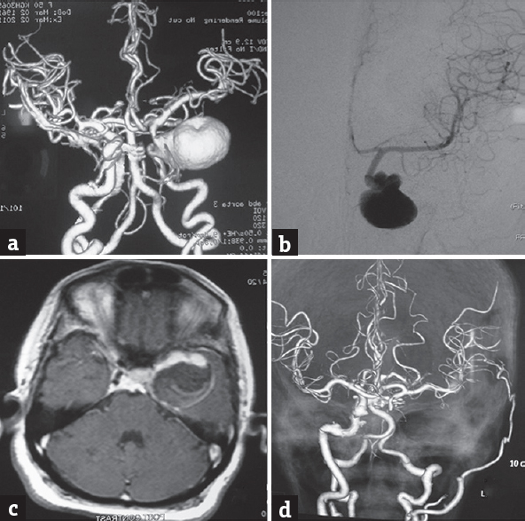 (a and b) Computed tomography angiogram and (a) 4-vessel digital subtraction cerebral angiography, (b) a giant cavernous aneurysm on the left side. (c) Magnetic resonance imaging brain T1-weighted contrast sequence suggestive of intramural thrombus, (d) postoperative computed tomography angiogram showing nonfilling of the aneurysm and a patent superficial temporal to middle cerebral anastomosis