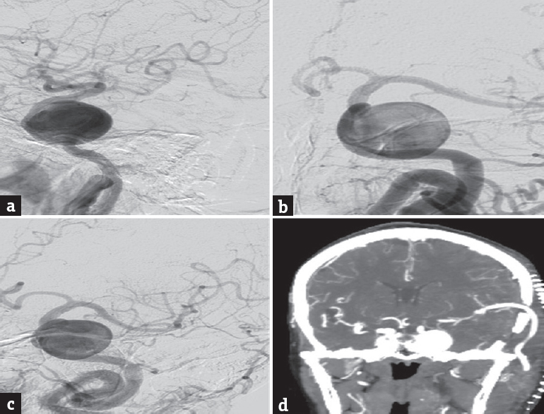 (a-c) Left internal carotid artery digital subtraction cerebral angiography-lateral (a), anteroposterior (b) and oblique (c) images showing a giant left cavernous carotid artery aneurysm, (d) computed tomography angiogram (postoperative – before carotid ligation) showing a patent high-flow saphenous vein graft from the cervical external carotid artery to middle cerebral artery