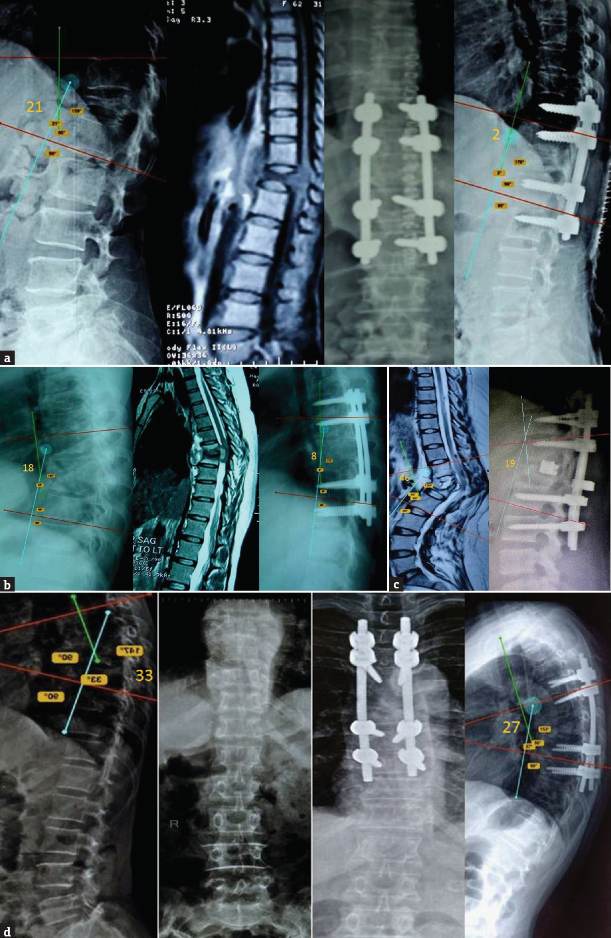 (a-d) Imaging profile of some patients showing the preoperative and postoperative pictures