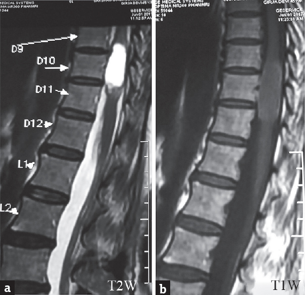 (a and b) Sagittal T1- and T2-weighted images showed hypointense and well-defined hyperintense lesion at D9–D10 level, respectively