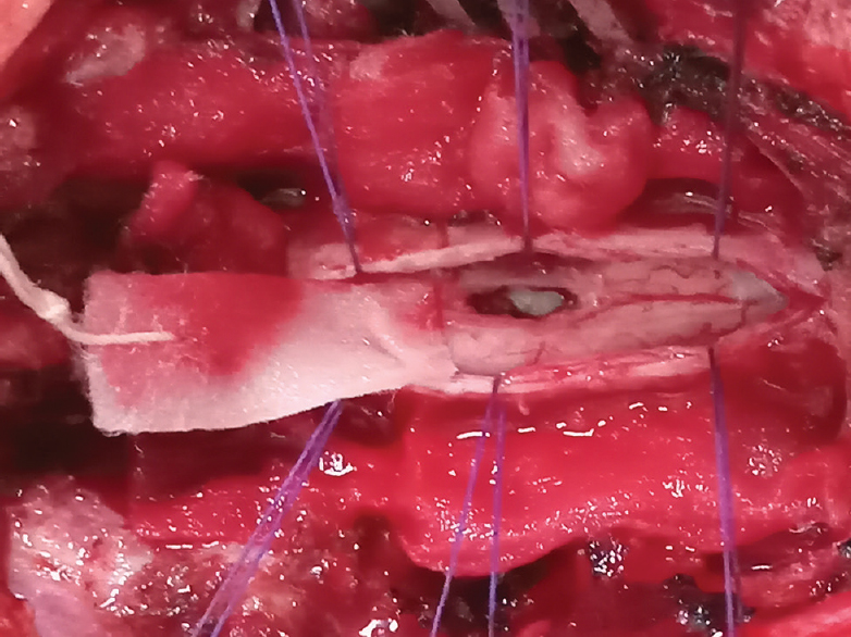 Intra-operative image showing dorsomedian myelotomy with aspiration of arachnoid cyst