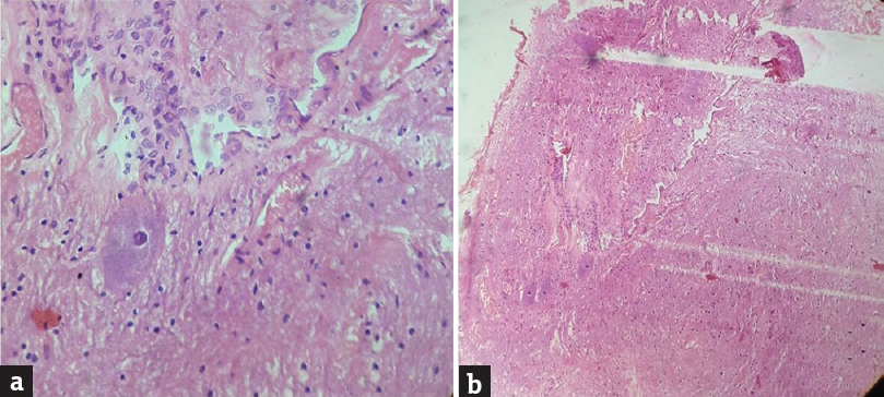 (a and b) Histopathology of intramedullary cyst wall. Cuboidal cystic lining resting on fibrocartilagenous tissue (stroma) with irregularly shaped cells (H and E, ×5 and ×10 respectively)