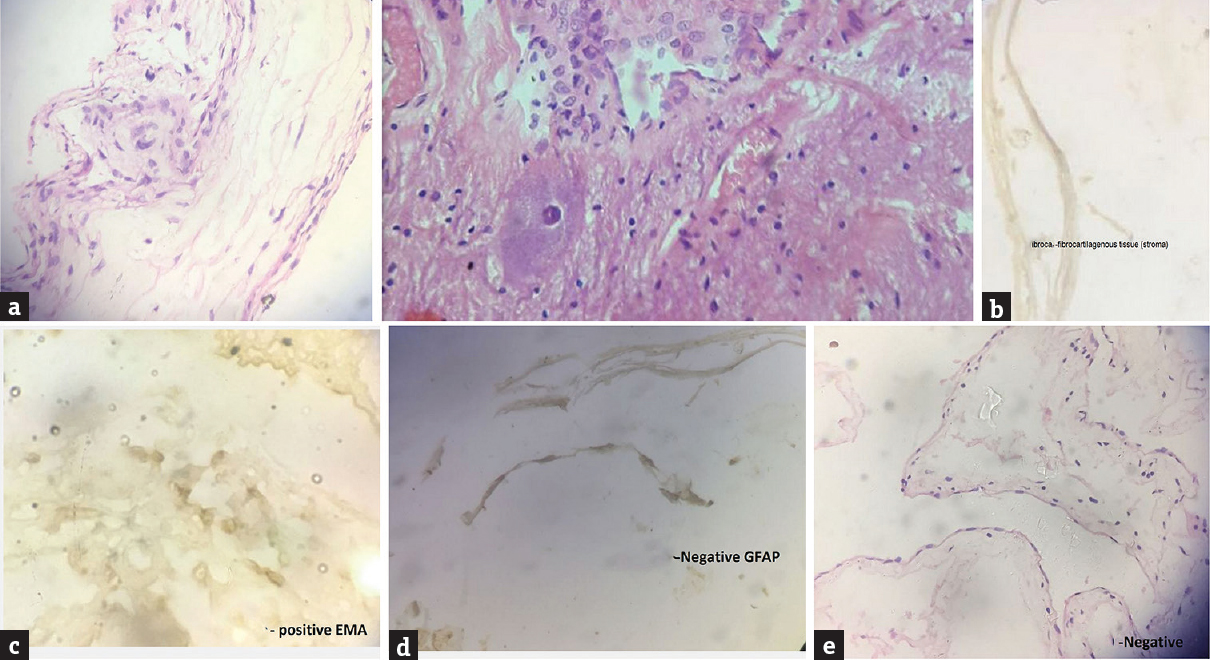 Immunohistochemistry of intramedullary cyst. (c) The lining epithelial cells express epithelial membrane antigen. (a-e) Negative control slide for S100, P53, carcinoembryonic antigen, glial fibrillary acidic protein does not express target antigen. (immunoperoxidase against epithelial membrane antigen are from biogenix, ×10)