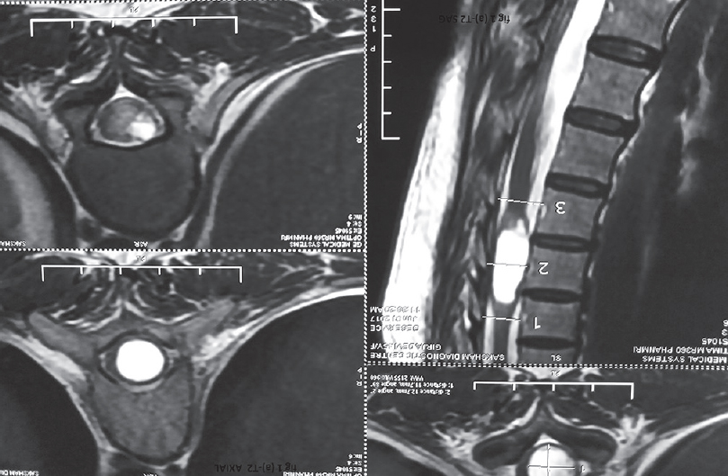 (a and b) Magnetic resonance imaging of the dorsal spine. Sagittal T2-weighted images depicting well-defined, hyperintense lesion at D11–D12 with no perilesional signal changes, axial T2-weighted images shows intramedullary which is hyperintense and expanded cord seen