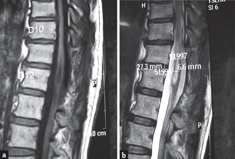 Follow-up magnetic resonance imaging scan done after 11 month showed a cystic mass hypointense on T1 and hyperintense on T2 of size 27 mm × 6 mm suggestive of recurrence