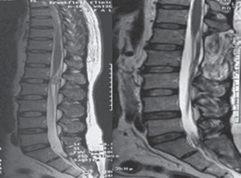 Preoperative and postoperative T2 magnetic resonance imaging showing L1 ependymoma