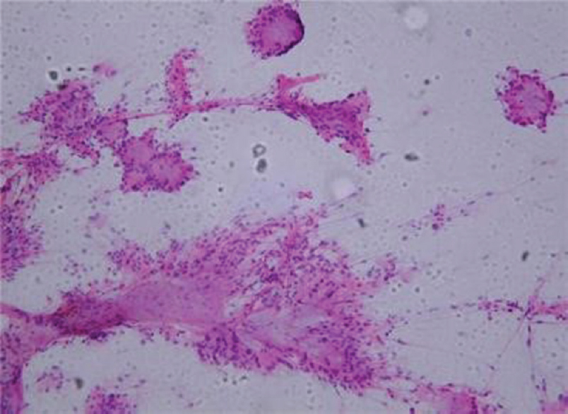 Smear of resected ependymoma showing moderately glial derived and focally myxoid lesion