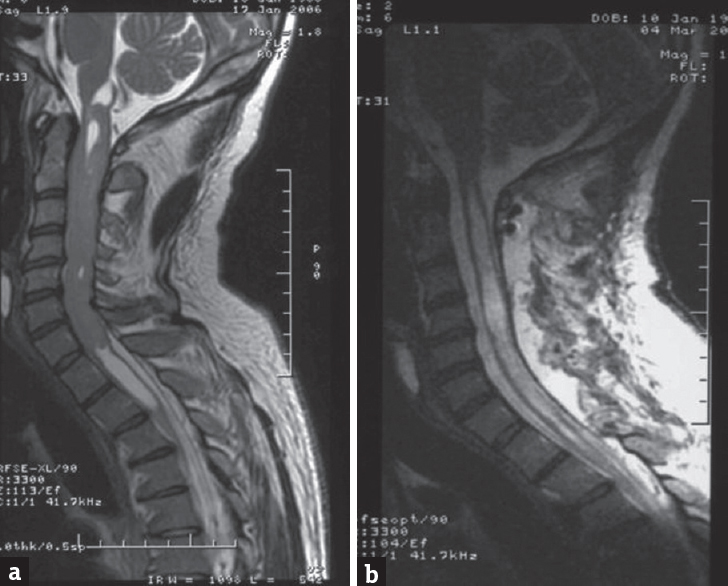 (a) Extensive cervical ependymoma with associated syrinx and (b) postoperative image showing total resection