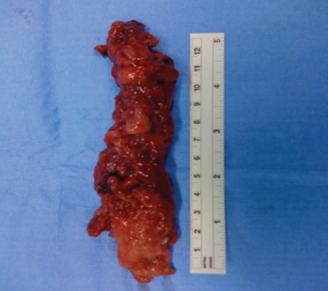 Picture of a large cervicodorsal ependymoma resected en bloc