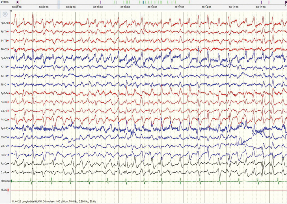 Electroencephalography shows triphasic waves with no alpha rhythm