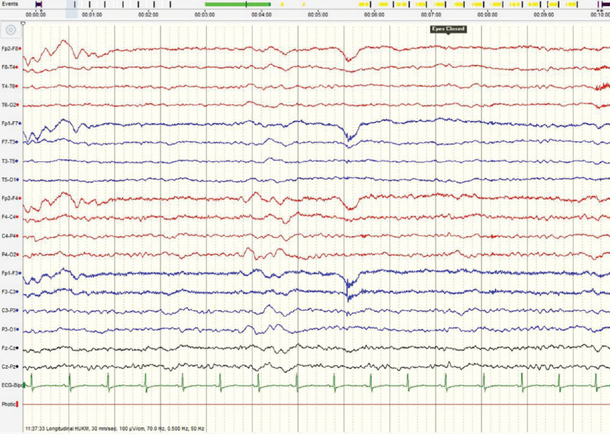 Electroencephalography shows the resolution of triphasic waves