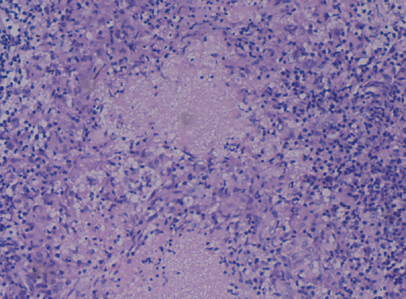 Histopathology image with granuloma