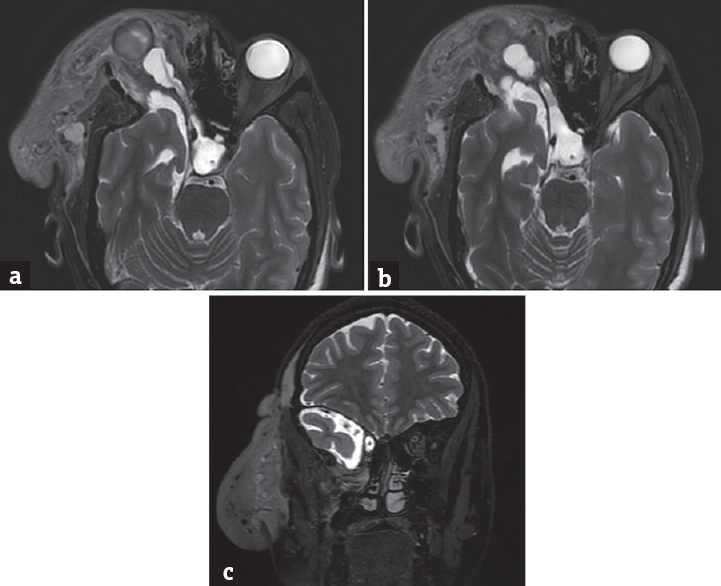 Dural ectasia of optic nerve. (a) Axial T2WI shows a large sagging mass (neurofibroma) arising from the right palpebral soft tissues and infiltrating into the orbit (block white arrow). The tubulocystic dilation of the CSF sheath around a thin right optic nerve can be seen extending all the way upto the optic chiasm (thin white arrow). The deformed, proptosed right globe with hemorrhagic contents can also be seen (block black arrow). (b) Axial T2WI at a slightly caudal level shows tubular dilation of the CSF sheath around the intracranial portion of the right optic nerve and the optic chiasm. The enlarged right middle cranial fossa (due to dysplastic sphenoid bone) with herniating anterior temporal pole and widened CSF spaces can be seen (black arrow). (c) Coronal T2WI shows the dilated CSF sheath around the intracranial segment of right optic nerve (thin white arrow), widened CSF spaces of the dysplastic and enlarged right middle cranial fossa (black arrow), and sagging right palpebral neurofibroma (block white arrow)