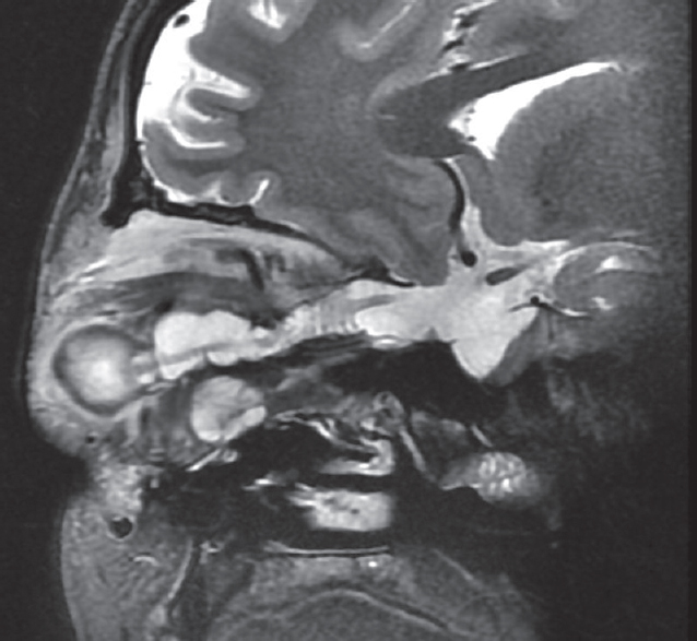 Complete extent of dural ectasia. Sagittal T2WI shows the entire extent of dural ectasia from the optic nerve head to optic chiasm. Note the thin T2 hypointense optic nerve coursing through it