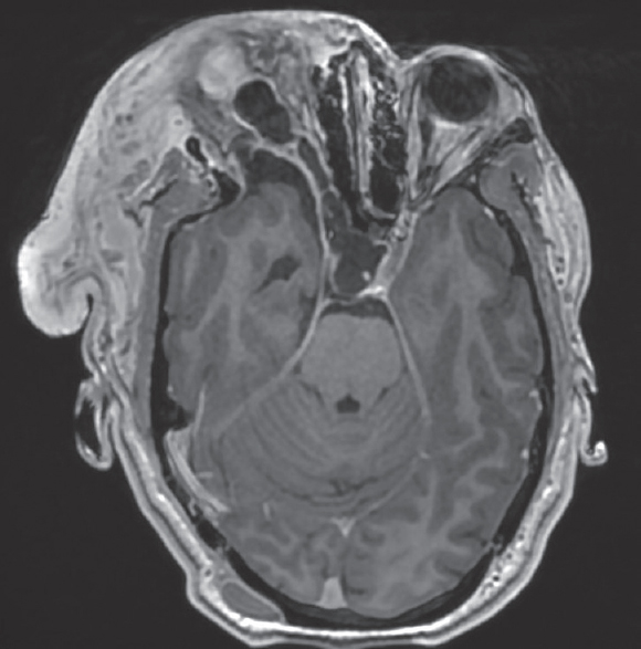 Contrastenhanced MRI. Contrast enhanced axial T1WI show the dilated perioptic CSF sheath with smooth and sharp enhancement of the dura outlining it. No internal areas of enhancement are seen within it. Note the heterogeneous enhancement of the palpebral neurofibroma