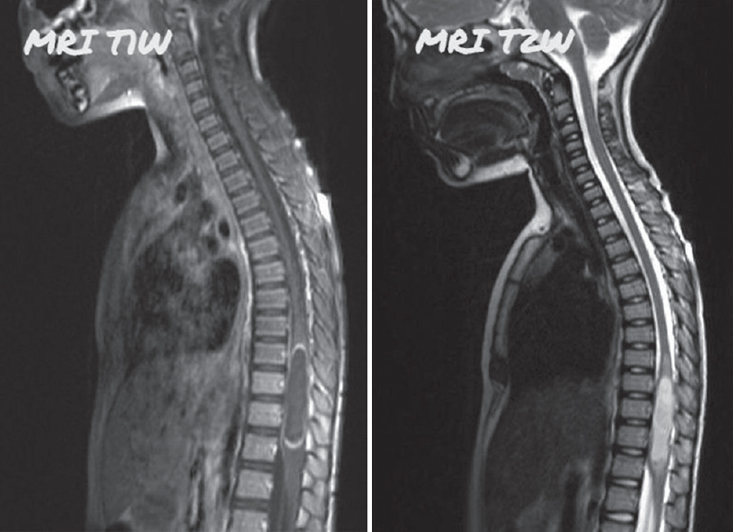 Magnetic resonance imaging shows an intradural intramedullary cystic lesion of 4.9 cm × 1.1 cm size at D9 to D12 region, which was hypointense on T1W1, hyperintense on T2W2