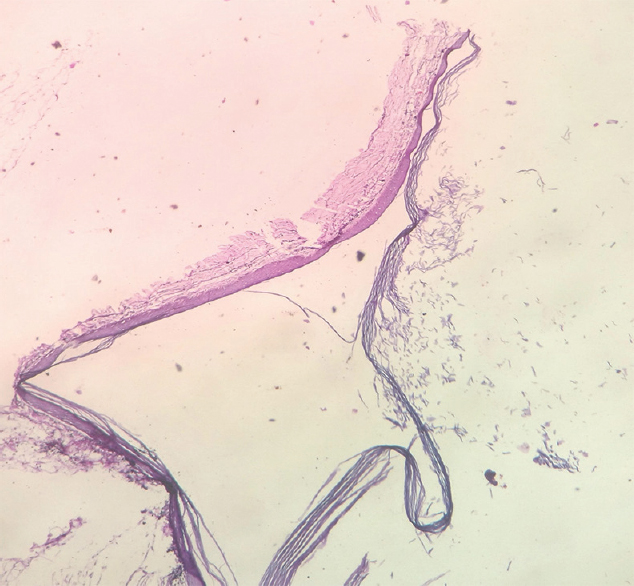 Histopathological image showing stratified squamous epithelium of keratinizing variety suggestive of epidermoid cyst