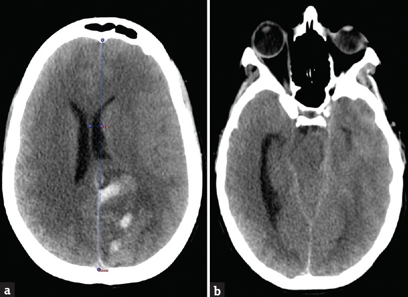 Computerized tomography of the brain axial sections; (a) section through frontal horns of the lateral ventricles showing left parietooccipital hemorrhage with a left-to-right midline shift and diffuse cerebral edema. (b) Section through the temporal horn of the lateral ventricle showing obstructive hydrocephalus with trapped left-sided temporal horn and severely dilated the right temporal horn. The section also shows effacement of quadrigeminal and basal cisterns concerning for impending herniation