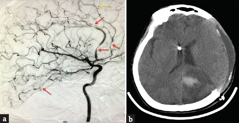 (a) Digital subtraction angiography of the brain, selective left internal carotid artery injection showing multifocal segmental vasoconstriction of the anterior cerebral and posterior cerebral arteries (red arrows). Left frontal lobe parenchymal intracranial pressure probe is also seen (yellow arrow). (b) Computerized tomography of the brain axial section showing left-sided parietooccipital intracerebral hemorrhage with decompressive hemicraniectomy and external herniation. A right frontal external ventricular drain is also seen