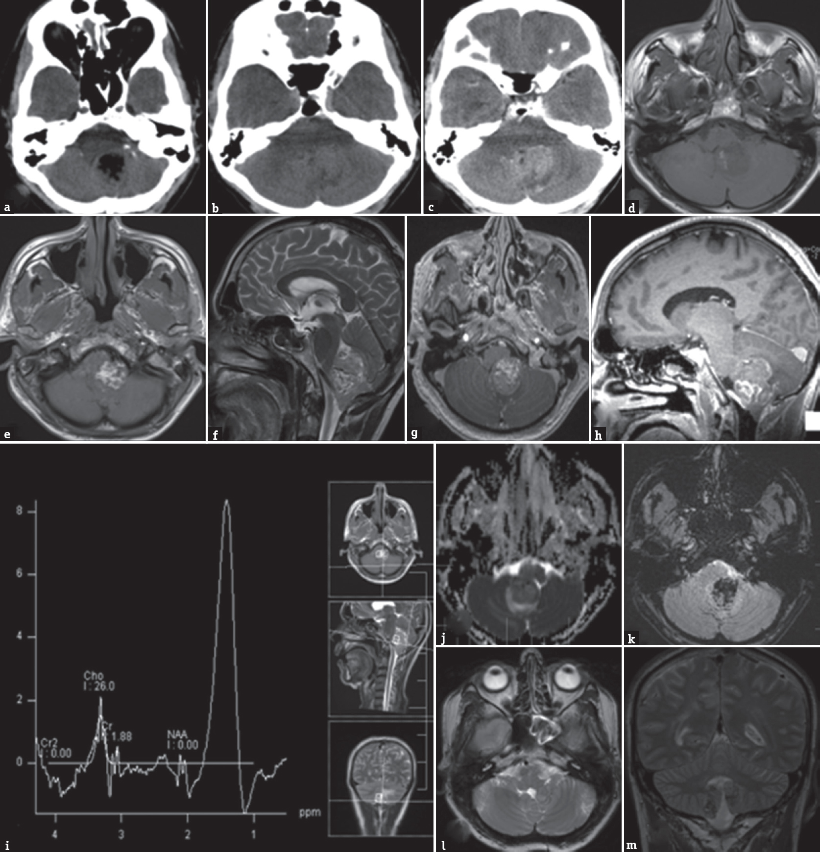 Computed tomography brain (a and b) plain and contrast-enhanced (c) images show a mass lesion in the posterior fossa, with hyperdense superior component, with moderate enhancement. The inferior component is hypodense, has Hounsfeld unit of-31, suggesting fat. Magnetic resonance imaging brain T1 axial images (d and e) showed heterointense lesion involving vermis and fourth ventricle, with hyperintense inferior component and isointense superior component, with similar signal changes in T2 sagittal images (f). Mild enhancement was noted with contrast (g and h). Few areas of restricted diffusion were noted (j). Gradient echo sequence showed abundant blooming of the hyperintense component, suggesting fat (k). MRS showed lipid peak in the region of 1.3 ppm (i). Follow-up magnetic resonance imaging brain 42 months after surgery showed a small asymptomatic residue in the vermis (l and m)