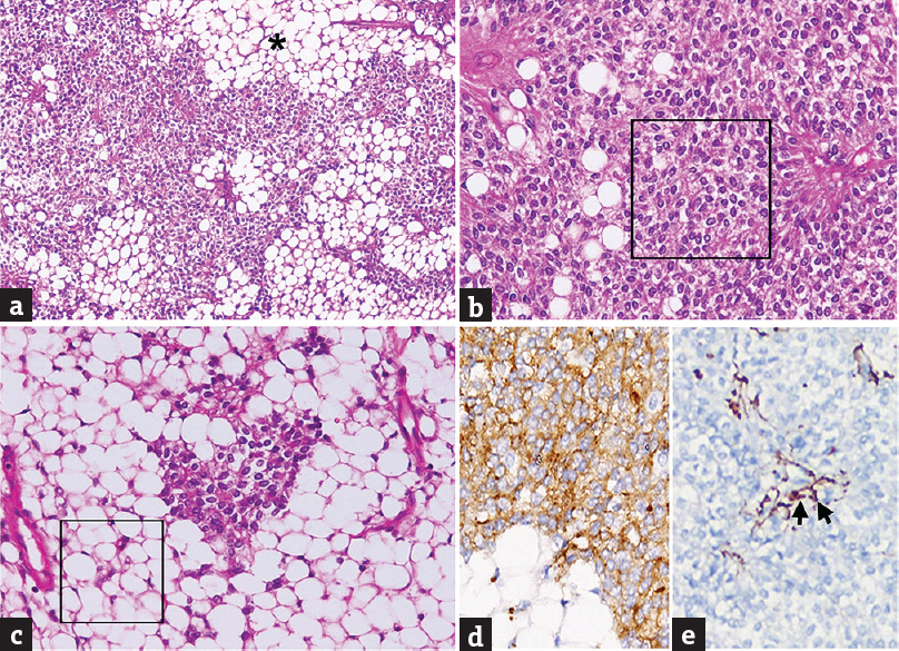 Liponeurocytoma. (a) Moderately cellular tumor composed of sheets of round cells, the neurocytes, interspersed with islands of mature adipose tissue (*). (b) Predominantly neurocytic area composed of relatively isomorphic cells with bland, round to oval, vesicular nuclei and moderate, clear to eosinophilic cytoplasm (square). (c) The lipomatous component is composed of mature adipocytes with abundant clear cytoplasm (square). (d and e) The neoplastic neurocytic cells are positive for synaptophysin (d) and negative for glial fibrillary acidic protein (e). A few perivascular reactive astrocytes are labeled (arrows) (a: H and E, ×100; B and c: H and E, ×200; d: Synaptophysin immunostain, ×400; e: glial fibrillary acidic protein immunostain, ×400)