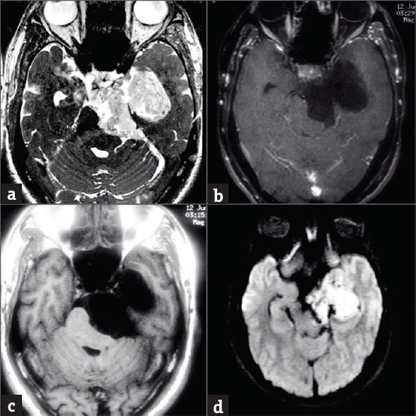 Preoperative images: (a) T2 CISS image showing hyperintense leon in the left cerebellopontine angle cistern, left Meckel's cave and left side of basilar, (b): Contrast image showing no contrast enhancement of lesion, (c): T1-weighted image hypointense lesion in the left cerebellopontine angle (d): Diffusion-weighted imaging image showing Diffusion restriction within lesion