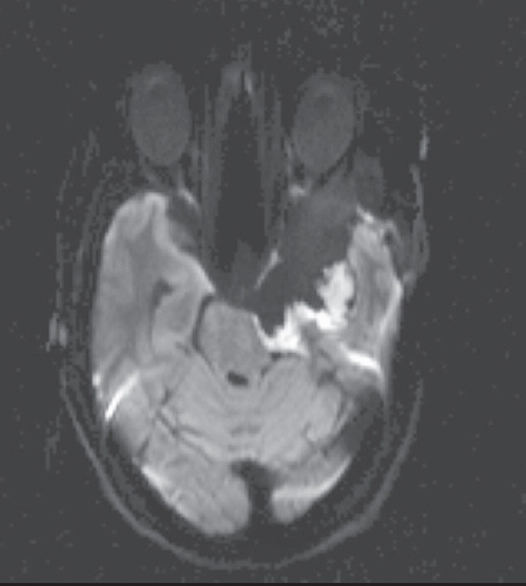 Diffusion-weighted imaging postoperative image suggestive of small residual in posterior part of resection cavity