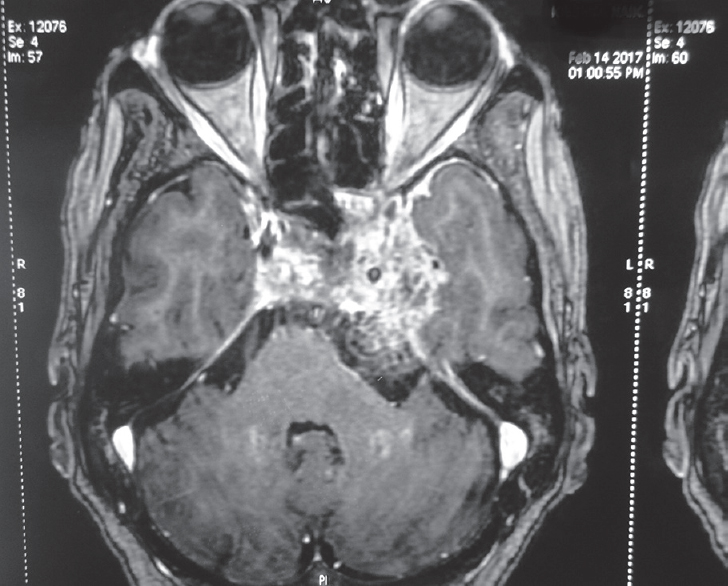 Multidetector computed tomography with contrast magnetic resonance imaging-heterogeneous lesion arising from the central skull base bones with intracranial extension and infiltration to the surrounding bones