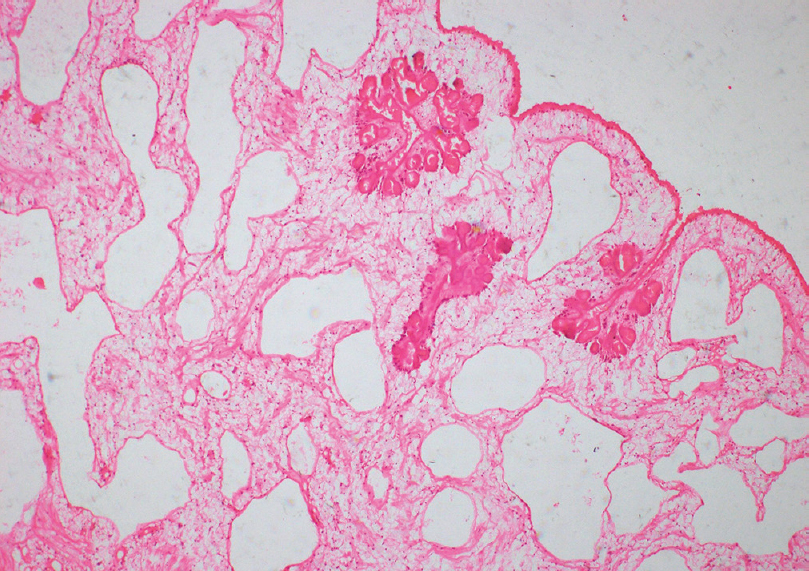 Coenurus with outer cuticular layer, subtegumental cyton, and invaginating scolices (H and E, ×40)