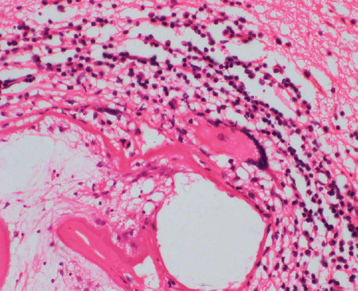 Mixed inflammatory cell response and giant cell reaction to the cyst (H and E, ×100)