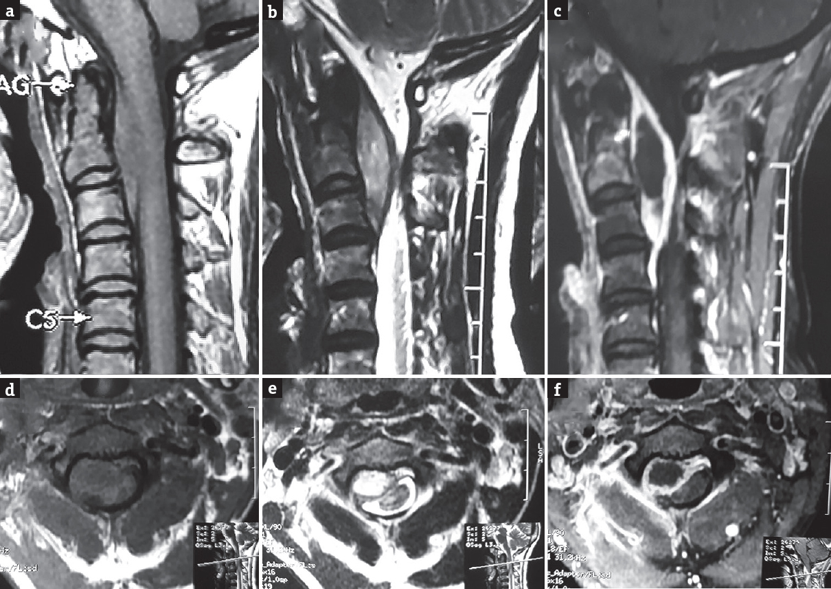 Magnetic resonance imaging cervical spine sagittal and axial view showing C2–C3 anterior epidural lesion which is isointense on T1-weighted images (sagittal view a, axial view d), hyperintense on T2-weighted images (sagittal view b, axial view e). Lesion showing peripherally contrast enhancement with central hypointensity (sagittal view c, axial view f)