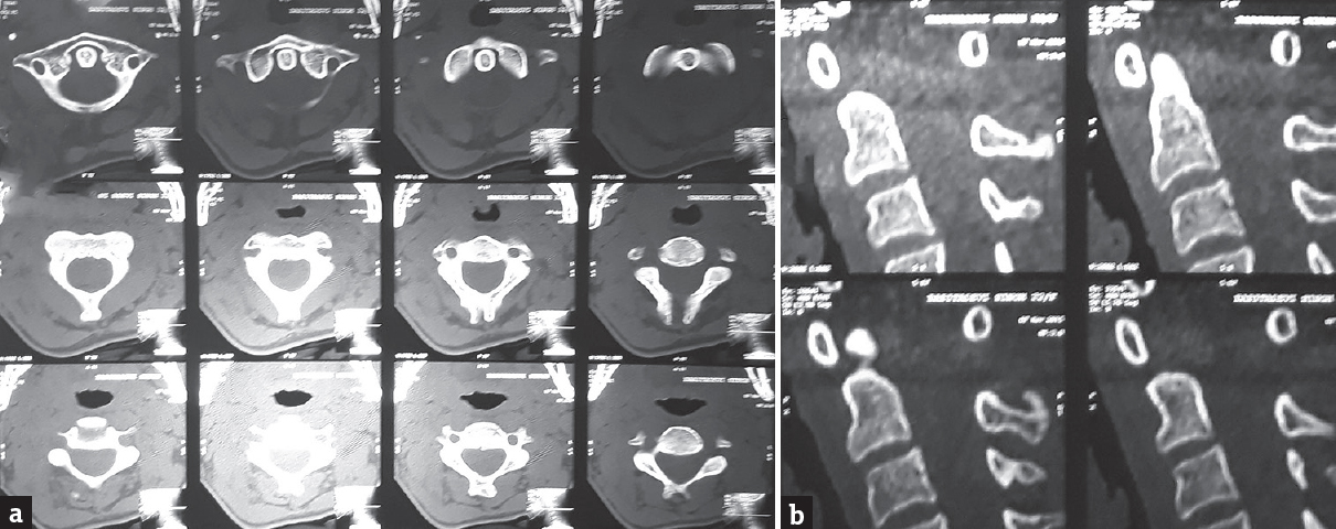 Computed tomography scan upper cervical spine; axial and sagittal views (a and b) showing no bony abnormality