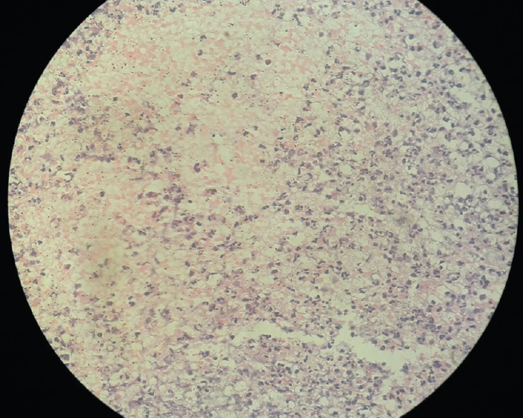 Histological picture showing evidence of tuberculous inflammation