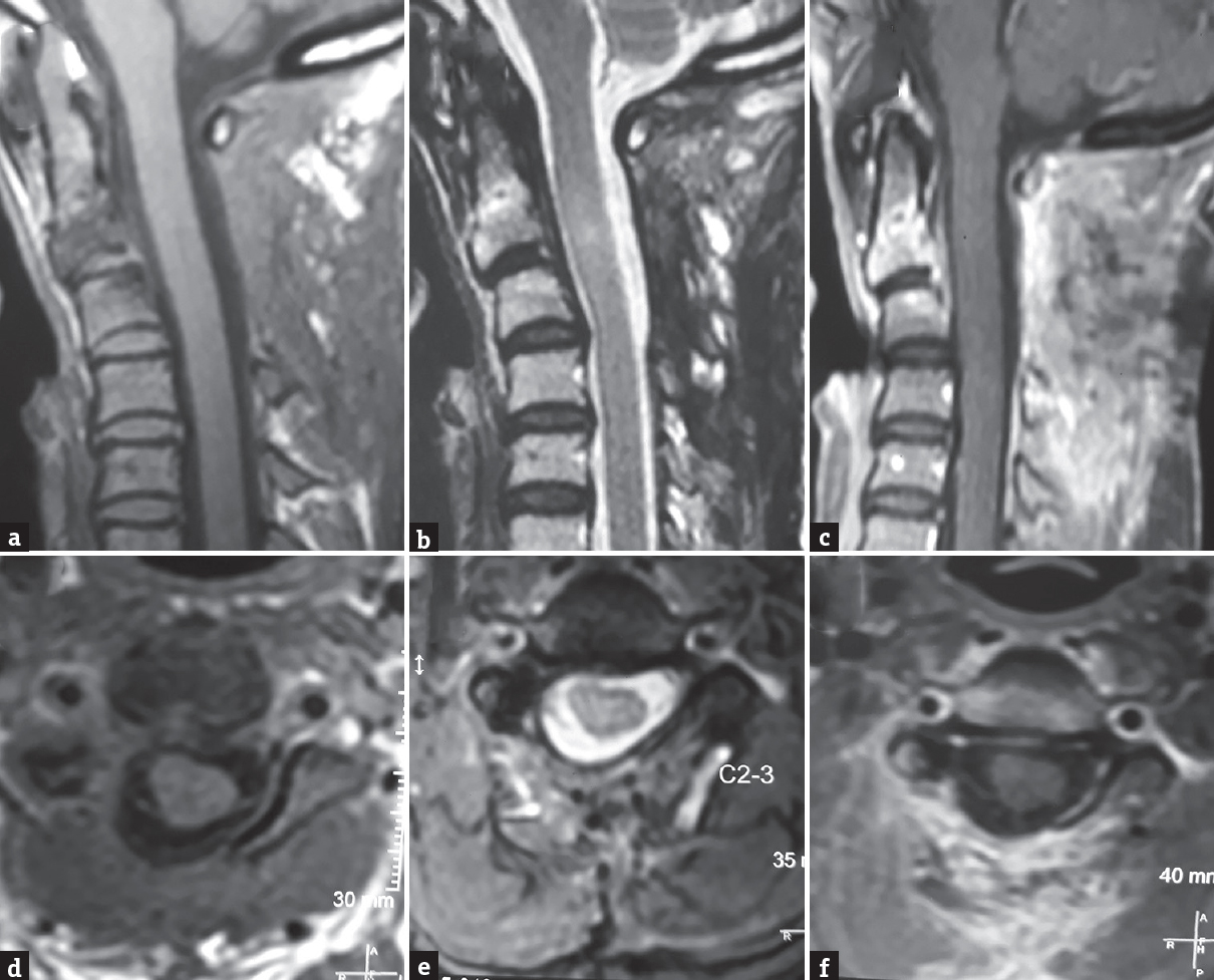 Postoperative magnetic resonance imaging cervical spine; sagittal, and axial T1 images (a and d), T2 images (b and e) and postcontrast images (c and f) showing no evidence of lesion at C2–C3 level