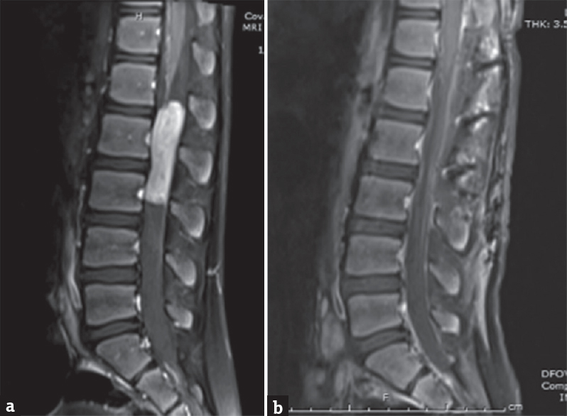 Preoperative (a) and postoperative (b) sagittal post contrast magnetic resonance imagings